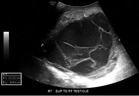 Testicular Cyst Ultrasound