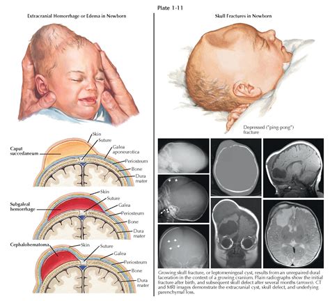 EXTRACRANIAL HEMORRHAGE AND SKULL FRACTURES IN THE NEWBORN - pediagenosis