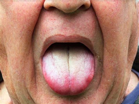 White Tongue Causes & 11 Natural Remedies to Make It Healthier - Origin ...