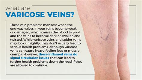 How to Treat Varicose Veins in Your 20s - LoungeDoctor.com – Lounge Doctor