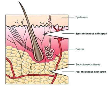 Skin Graft And Donor Site - University Hospitals Sussex NHS Foundation Trust