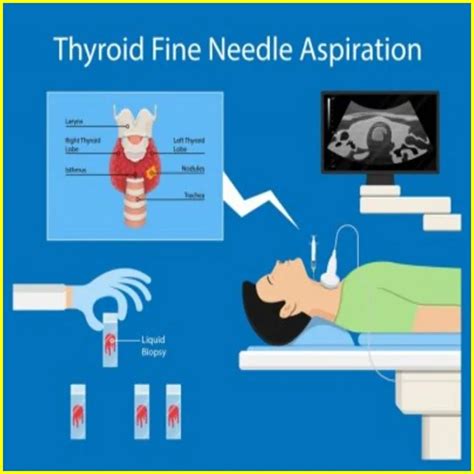 Thyroid Ultrasound Hashimoto's Archives - AR MEDICAL TECHNOLOGY