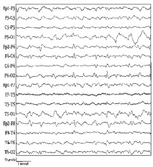 How to Read an EEG | Epilepsy Foundation