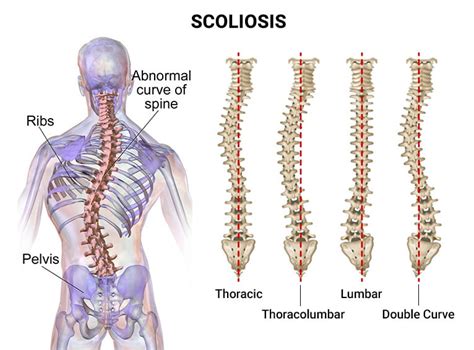 Scoliosis Wikipedia, 50% OFF | alumni.uod.ac