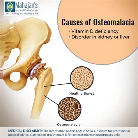 Osteomalacia Bone