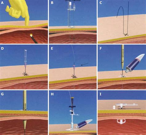 Usefulness of percutaneous endoscopic gastrostomy for supportive therapy of advanced ...