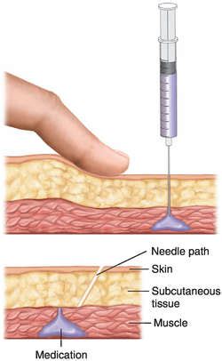 Intradermal Injection