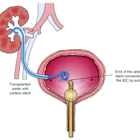 (PDF) Outcomes of Early Simultaneous Removal of Ureteric Stent With Indwelling Urethral Catheter ...