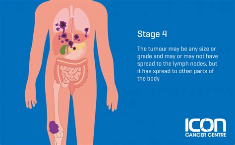 What is Soft Tissue Sarcoma? Soft Tissue Sarcoma Explained — Icon ...