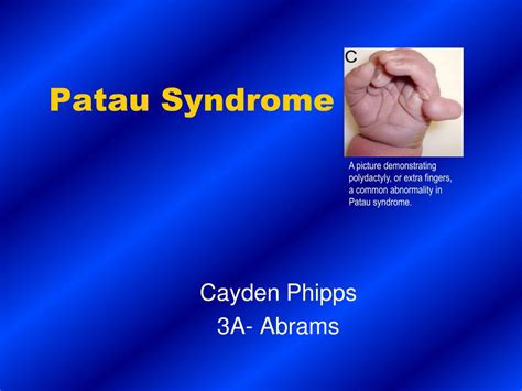 PPT - Patau Syndrome PowerPoint Presentation, free download - ID:6905046