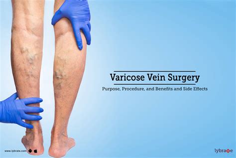 Varicose Veins Surgery: Purpose, Procedure, Benefits and Side Effects