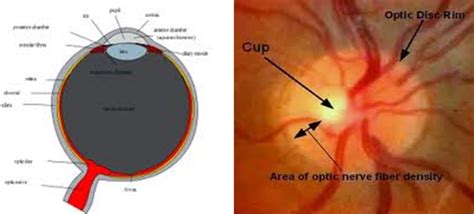 The Optic Nerve in Glaucoma | IntechOpen