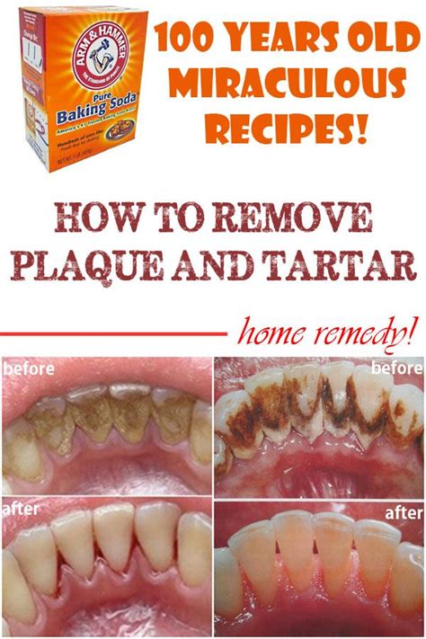 Home remedies to remove plaque and tartar - Beauty Tips Diary | Teeth ...