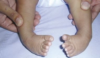 Congenital talipes equinovarus (clubfoot) - Surgery - Oxford International Edition