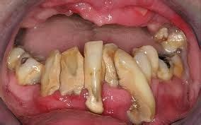 7 best Gross teeth images on Pinterest | Dental, Teeth and Tooth