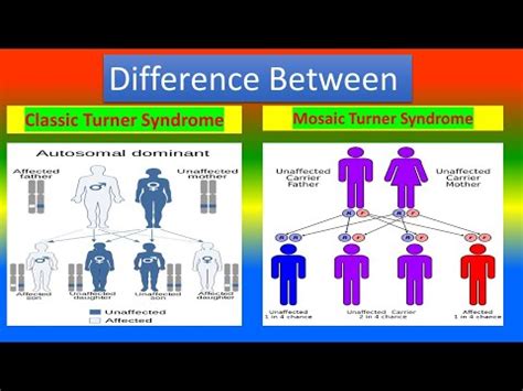 Classic Turner Syndrome and Mosaic Turner Syndrome - YouTube