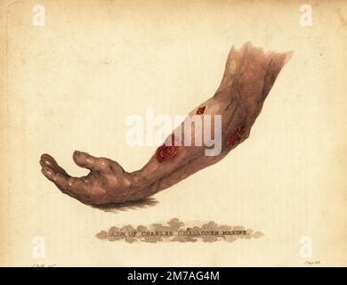 Bell gunshot wounds Stock Photo - Alamy