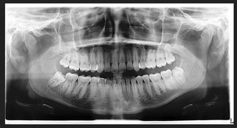 Why is a Panorex x-ray needed before wisdom teeth extractions? | Why is a Panorex x-ray needed ...