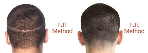 FUE Vs FUT Hair Transplant - SE Hair Clinic - Hair Transplant in Antalya Turkey