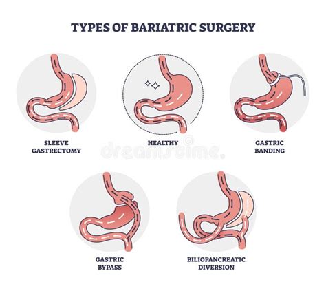 Types of Bariatric Surgery, it is Process for the Digestive System in ...