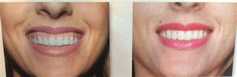 THE GUMMY SMILE, BOTOX CAN FIX IT! - Dr. Rita The Smile Designer Miami ...