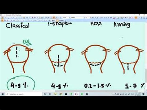 INCISIONS TYPES IN CESAREAN SECTIONS - YouTube