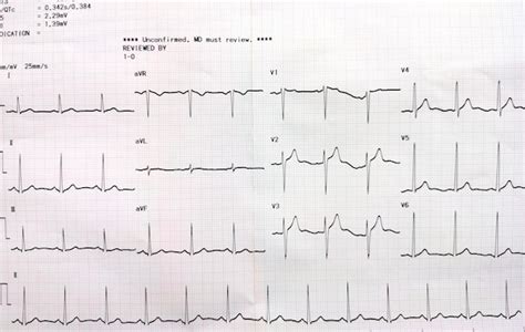 Premium Photo | Graph showing the results of the electrocardiogram ekg test on recording paper