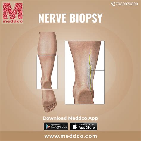 WHAT IS NERVE BIOPSY