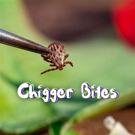 Dealing With Chigger Bites: Prevention And Treatment - BabieBlue