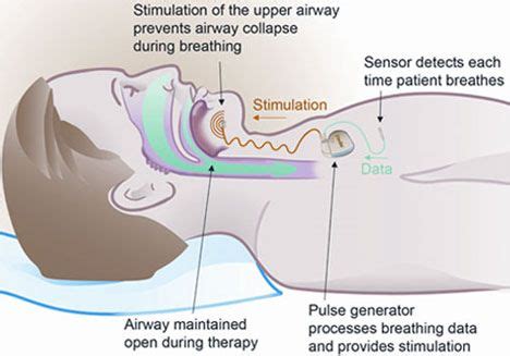 Nerve stimulation for sleep apnea | Nerve stimulator, Sleep apnea, Upper airway