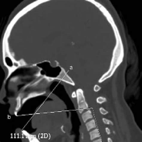 Various steps of operation. Uvula (arrow in A and B) has been... | Download Scientific Diagram