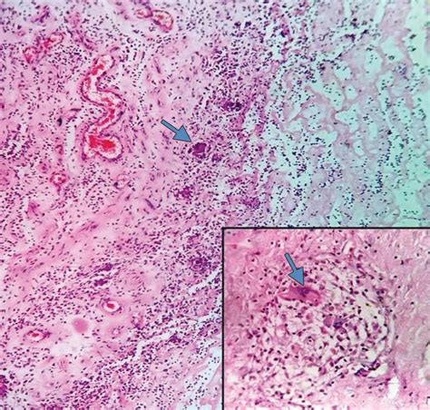 Peripheral Giant Cell Granuloma Histology