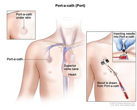 ER Nursing Skills: How to Access a Port-A-Cath, Video by Project ...