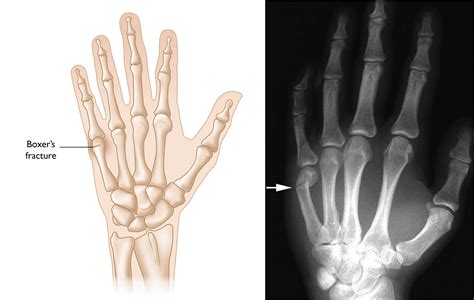 Finger Fractures - OrthoInfo - AAOS