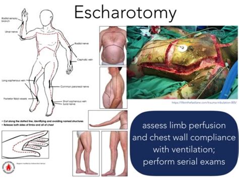 Burn and Inhalation Injury: ED Wound Care, Resuscitation & Airway | EM ...