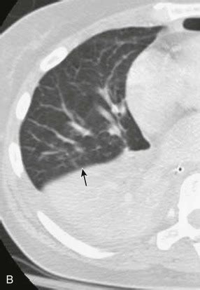 The Air Bronchogram Sign | Radiology Key