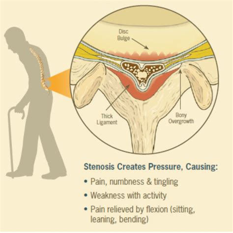 Ligamentum Flavum Hypertrophy