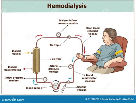 Hemodialysis Procedure. Used for the Renal Insufficiency Stock Vector ...