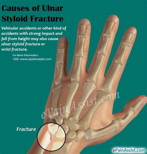 Pin on Ulnar-Sided Wrist Pain & TFCC Injuries