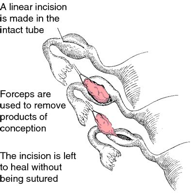 Salpingostomy | definition of salpingostomy by Medical dictionary