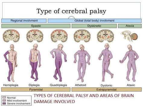 Cerebral Palsy