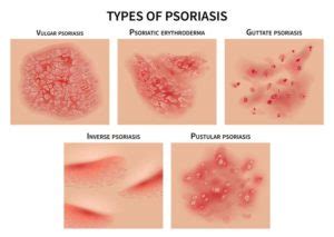 Psoriasis | Refocus On U