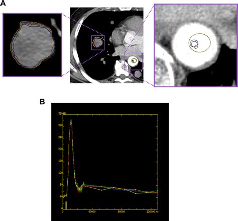 A 51-year-old male with metastatic right lung nodule from a spindle... | Download Scientific Diagram