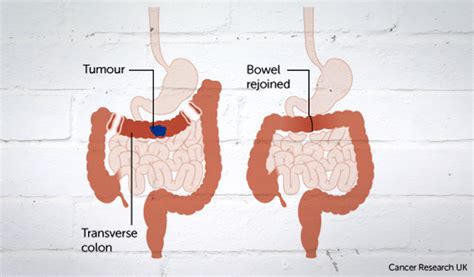 Effects Of Bowel Cancer On The Body - CancerWalls