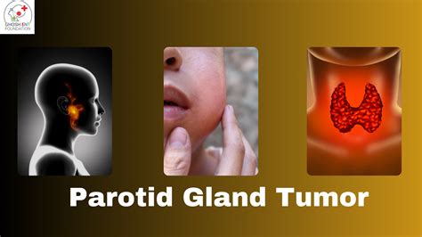 A Glimpse of Parotid Gland Tumors: What you need to know