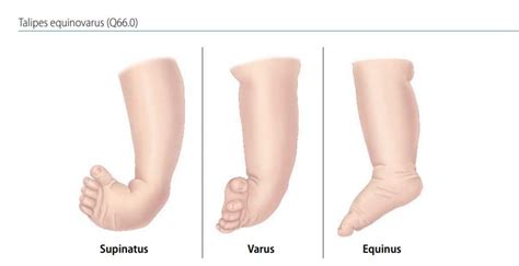 Varus club foot types 124441