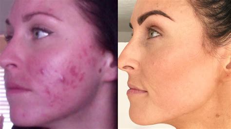 Blogger Juli Bauer Roth Shares Cystic Acne Before and After Photos - Allure