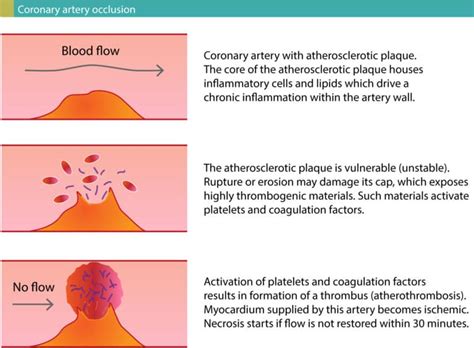 Diagnostic Criteria for Acute Myocardial Infarction: Cardiac troponins ...