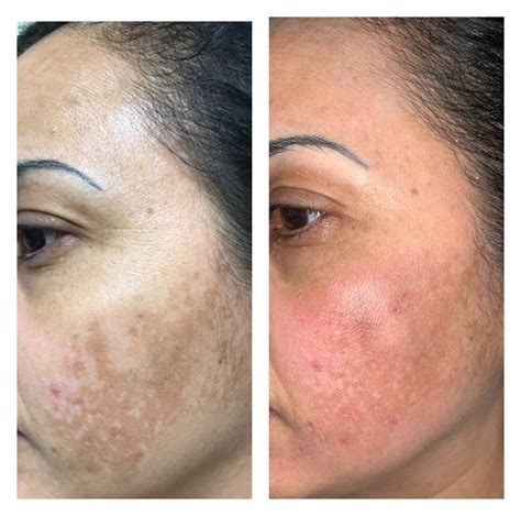 hyperpigmentation treatment in Raleigh, Raleigh hyperpigmentation treatment | Skin Essence A Day ...