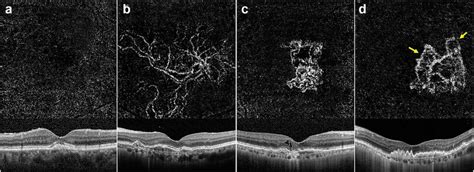 Optical coherence tomography angiography (OCTA) images (3 × 3 mm) with ...
